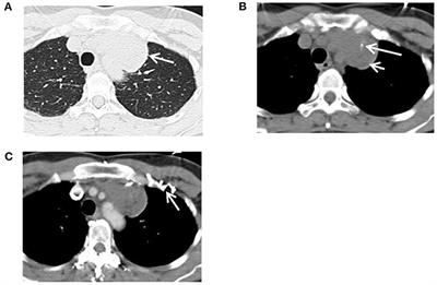 Long-Term Observation and Treatment of Epithelioid Haemangioendothelioma of the Mediastinum: A Case Report